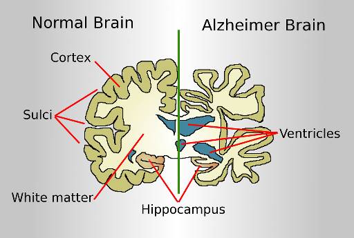 Normal brain vs Alzheimer brain